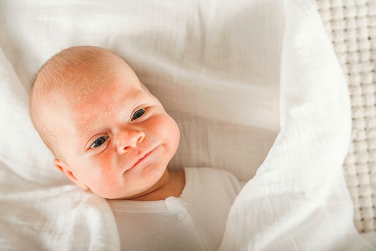 Rashes-in-the-Newborn-Period
