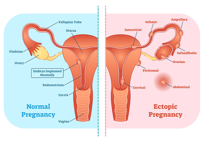ectopic-pregnancy